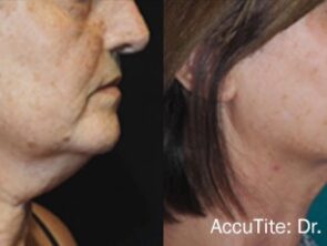 accutite-before-after-dr-p-rovatti-preview-1