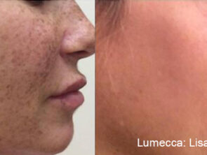 lumecca-before-after-dr-l-hartman-preview-1