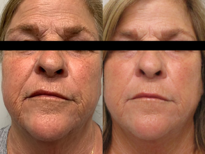 morpheus8-before-after-dr-s-harper-preview-1